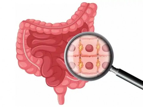 Sızdıran Bağırsak Sendromu ve Nedenleri